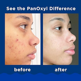 PanOxyl Acne Foaming Wash